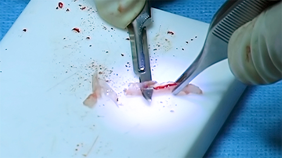 Carving harvested rib cartilage into a columellar strut for a rhinoplasty procedure.