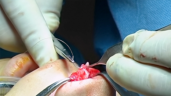 Placing the columellar strut and suturing it into the existing nose cartilage.