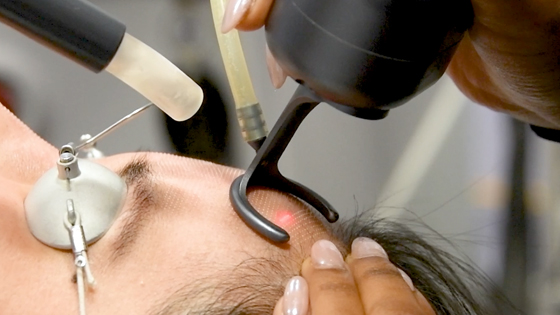 Close-up of CO2 fractional laser being used on patient's forehead.