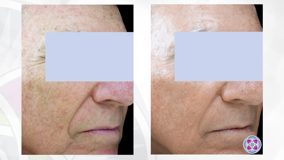 Before and after photos of a male who had a non-surgical-laser facelift treatment.