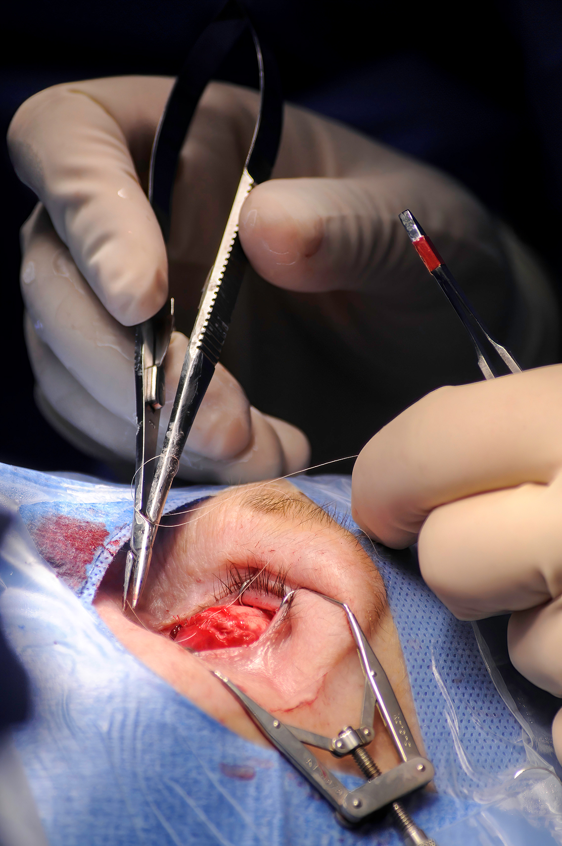 Begining to place sutures during an enucleation surgical procedure performed by oculoplastic surgeon.