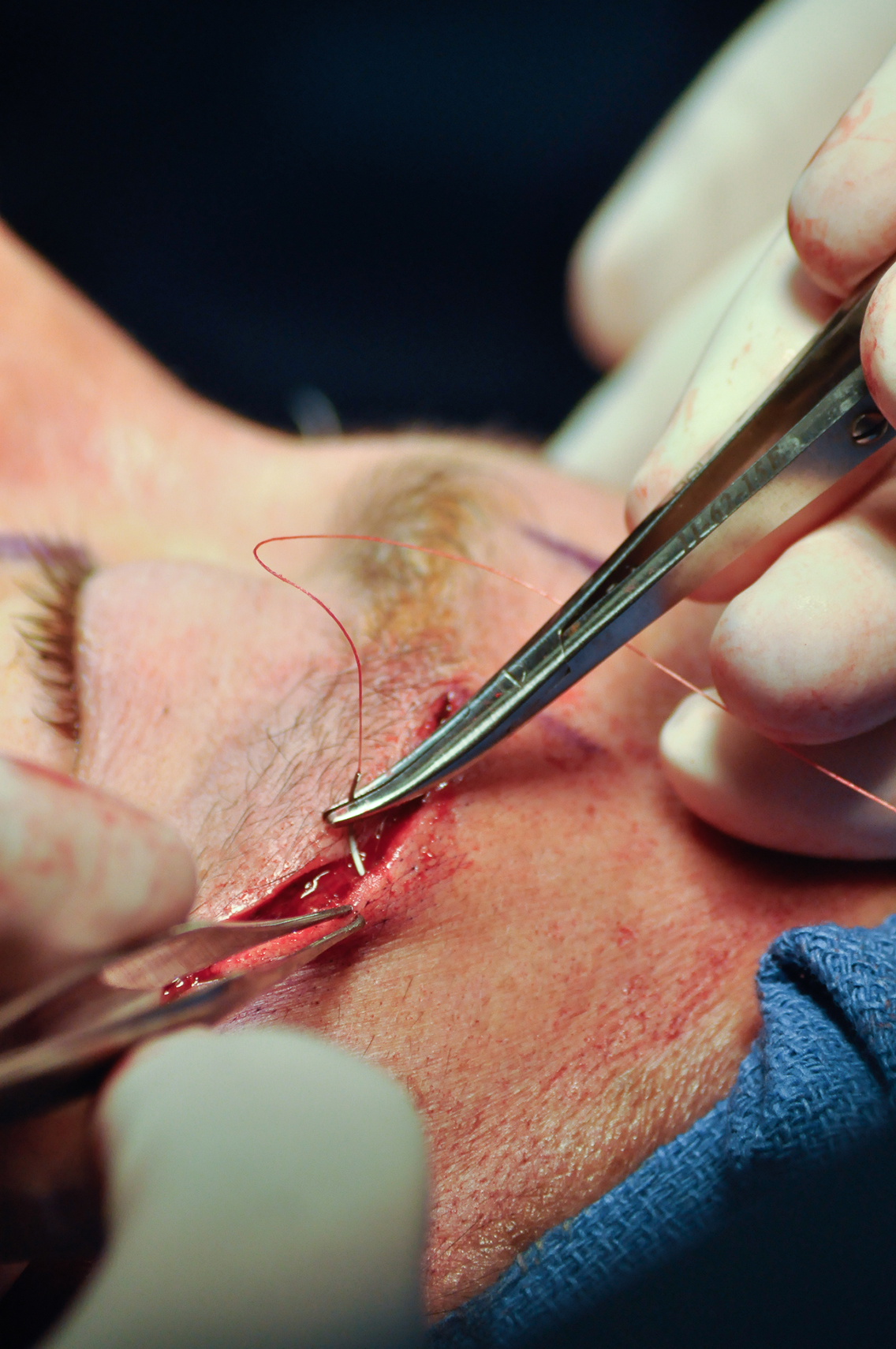 Close-up of sutures being placed during an upper eyelid blepharoplasty procedure.