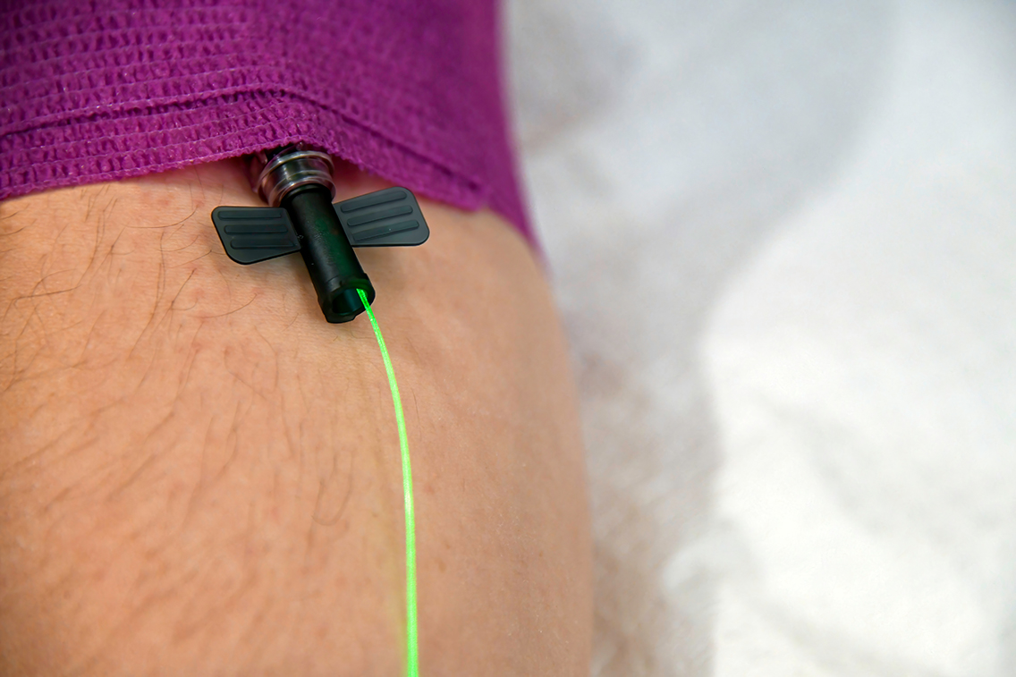 Close-up of a low level laser light therapy IV in a patient's arm