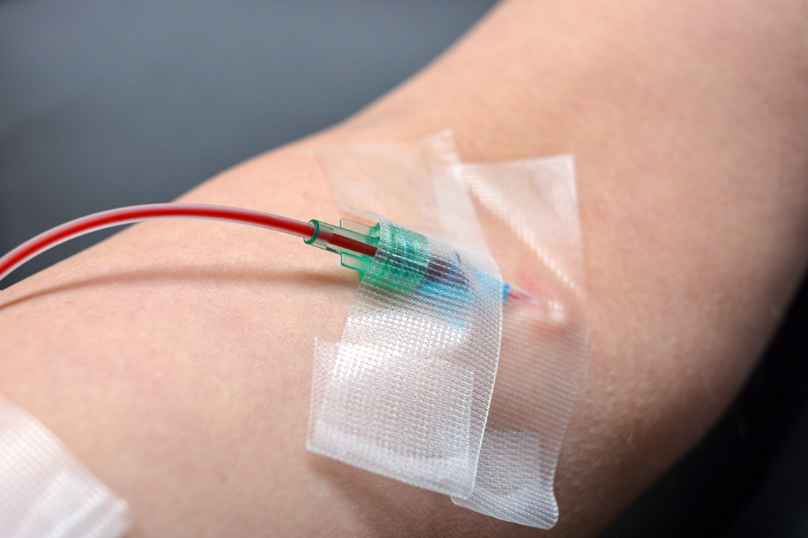 A single dose ozone therapy IV line in a patient's arm.