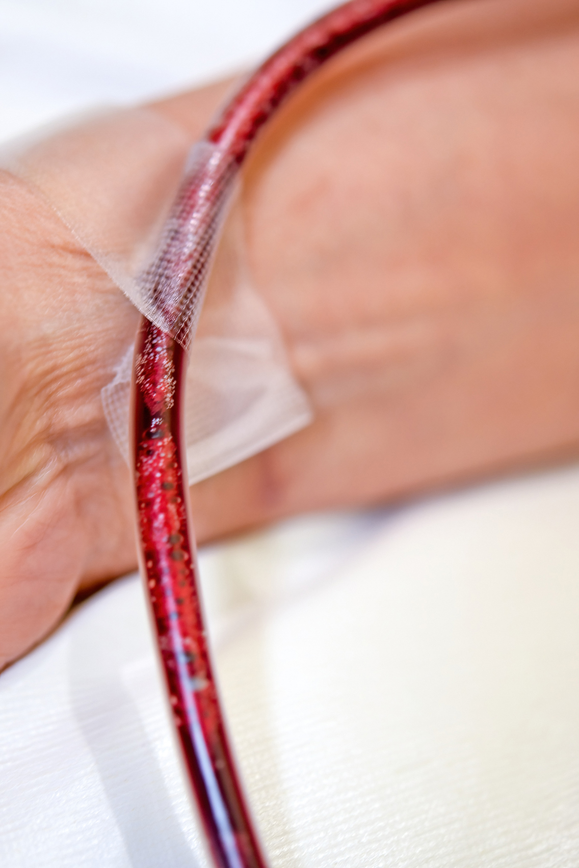 Close-up of debris being removed from blood during EBOO treatment.