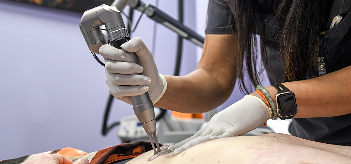 A nurse using an Nd YAG laser to remove a tattoo on a patient's abdomen