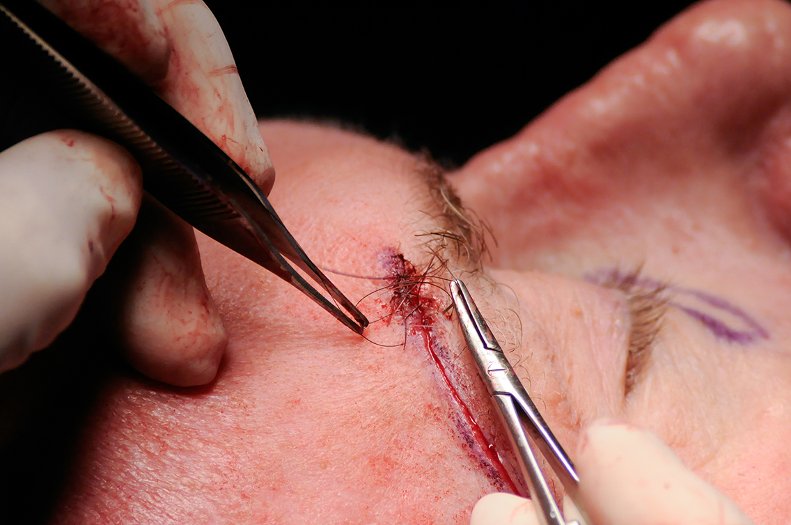 Close-up of surgeon suturing an upper eyelid blepharoplasty