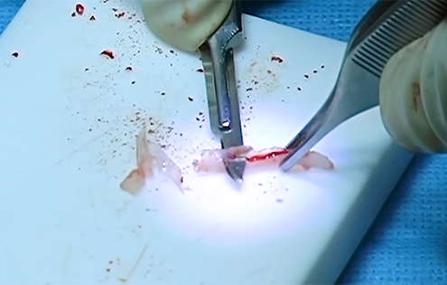 Carving harvested rib cartilage into a columellar strut for a rhinoplasty procedure.